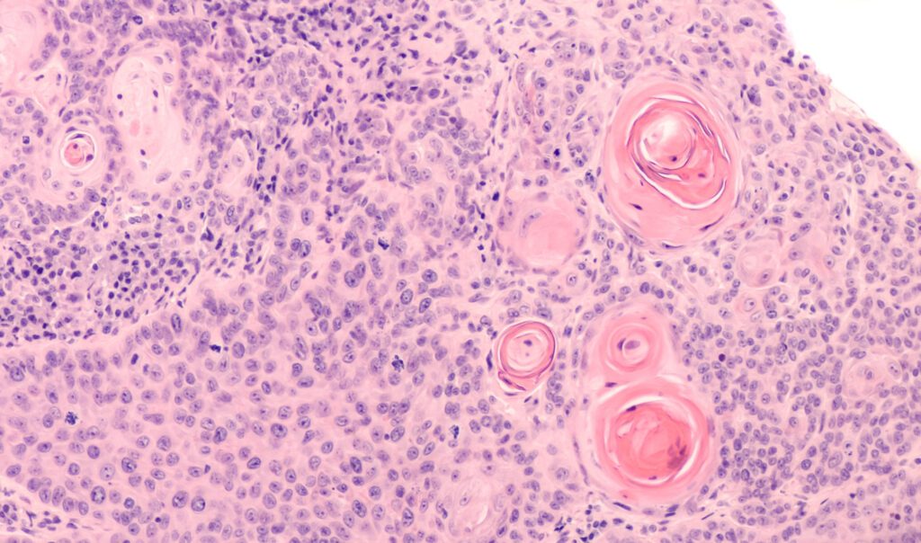 Photomicrograph of a CT (CAT) scan-guided needle core biopsy showing pulmonary squamous cell carcinoma, a type of non-small cell carcinoma